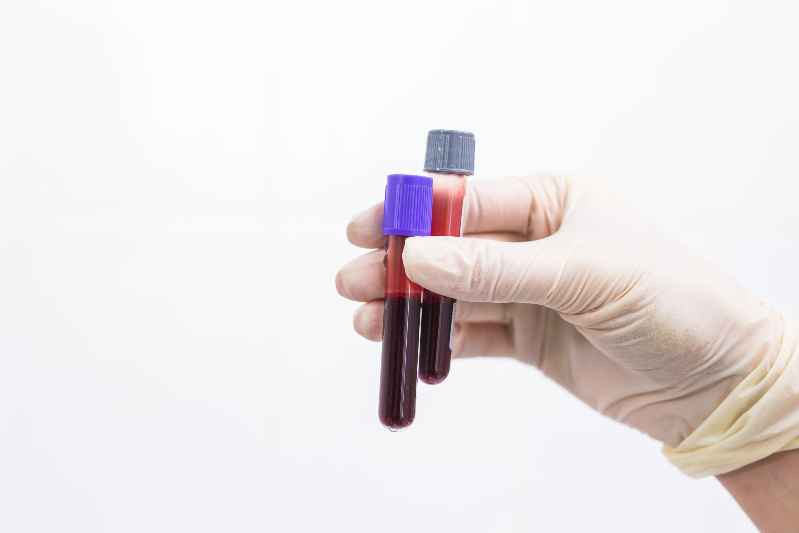Understanding the Ferritin Test: What It Is, Why It Matters, and How It Works